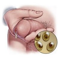 chlamydia secretion