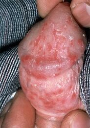discharge from the penis due to candidiasis